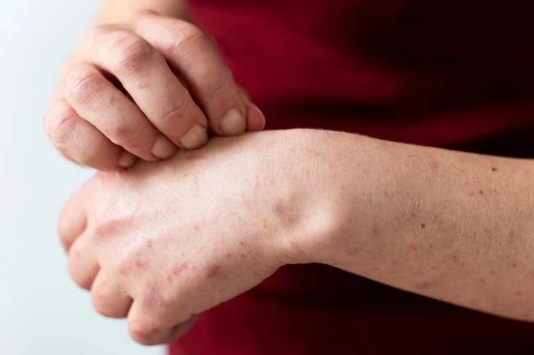 skin-allergy-person-s-arm